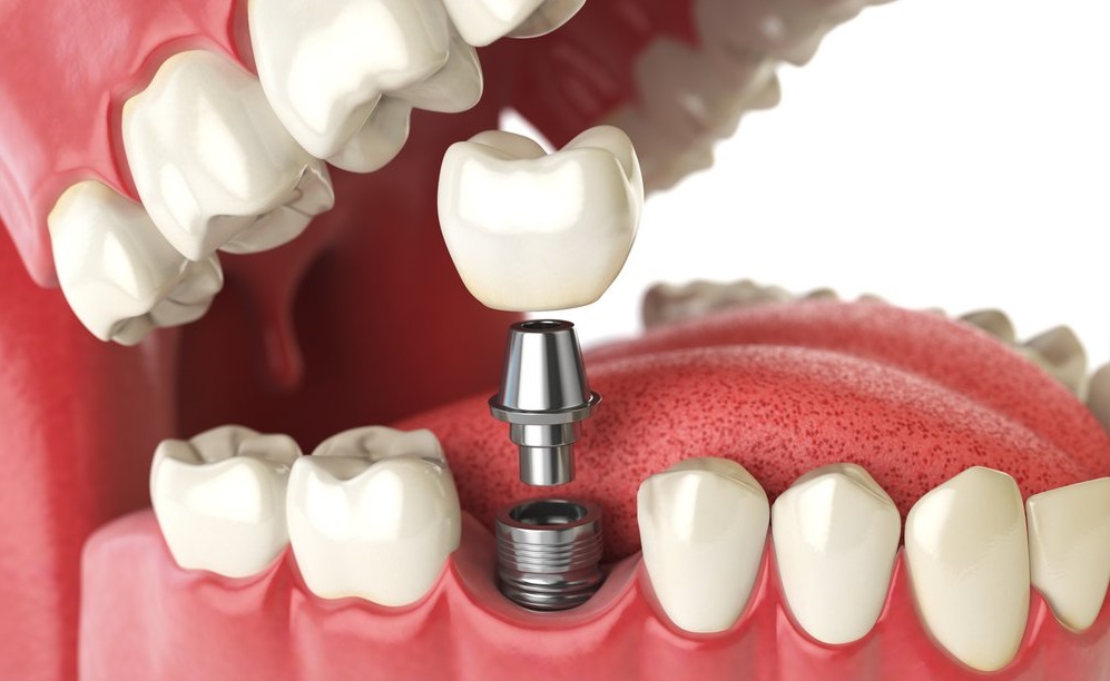 Имплантация зубов: Южнокорейские импланты и их преимущества