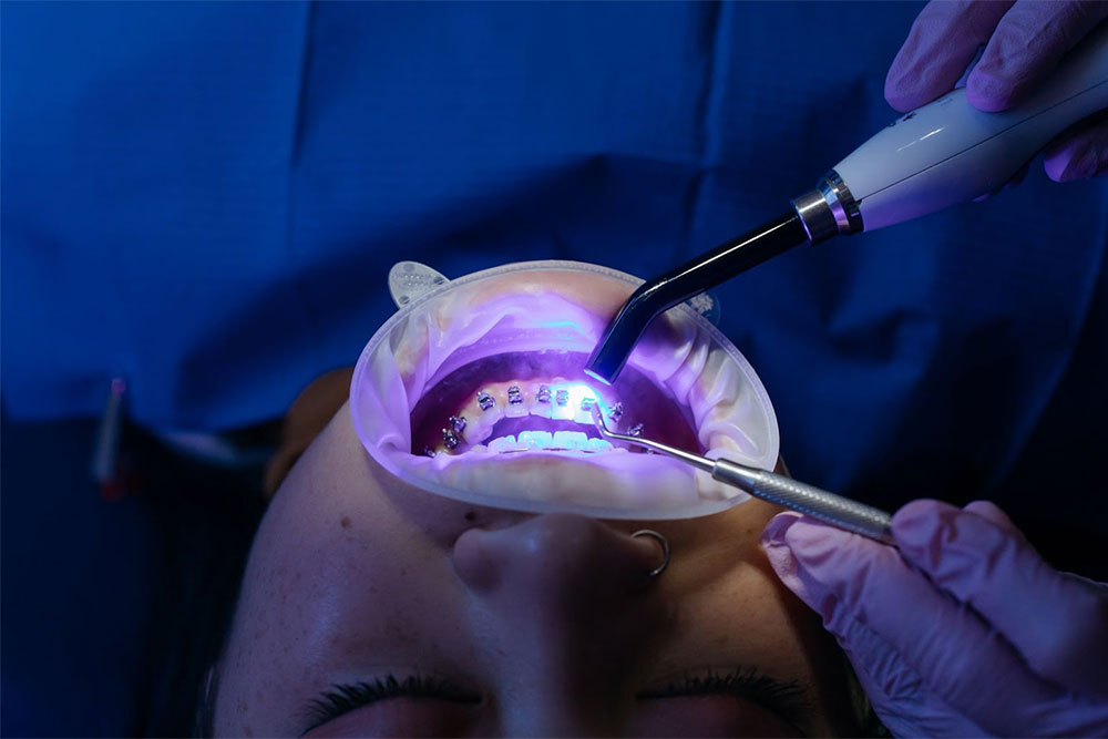 Ортодонтичні матеріали: ключовий елемент в корекції прикусу та виправленні усмішки